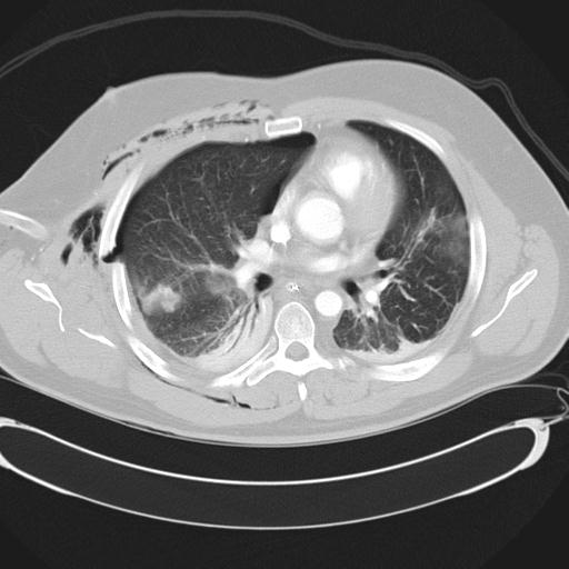 Bilateral traumatic renovascular injury (Radiopaedia 32051-32995 Axial lung window 27).jpg
