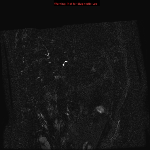 File:Biliary tree anatomical variant - biliary trifurcation (Radiopaedia 12531-12750 C 57).jpg