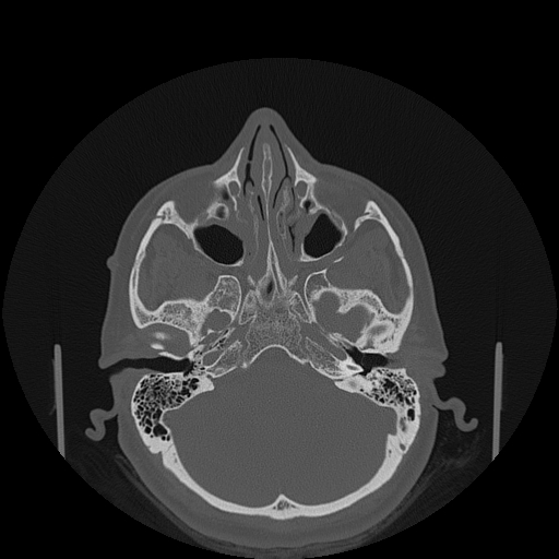 File:Bisphosphonate-related osteonecrosis of the jaw (Radiopaedia 71324-81642 Axial bone window 159).jpg