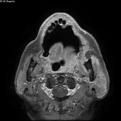 File:Bisphosphonate-related osteonecrosis of the maxilla (Radiopaedia 51367-57101 Axial T1 C+ fat sat 14).jpg