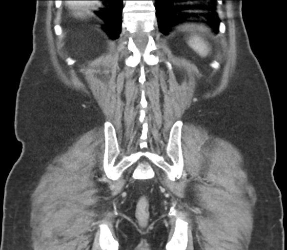 File:Bladder papillary urothelial carcinoma (Radiopaedia 48119-52951 C 53).png