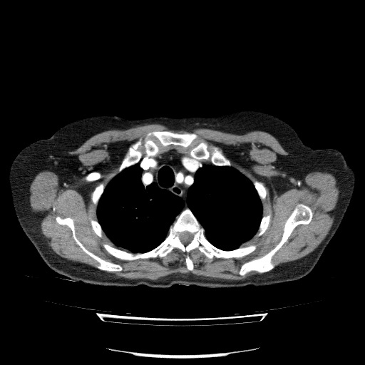 File:Bladder tumor detected on trauma CT (Radiopaedia 51809-57609 A 22).jpg