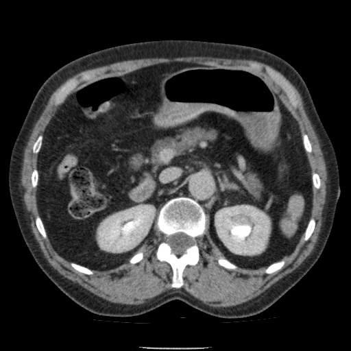 Bladder tumor detected on trauma CT (Radiopaedia 51809-57609 C 45).jpg