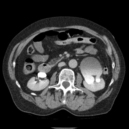 Bladder tumor detected on trauma CT (Radiopaedia 51809-57609 C 59).jpg