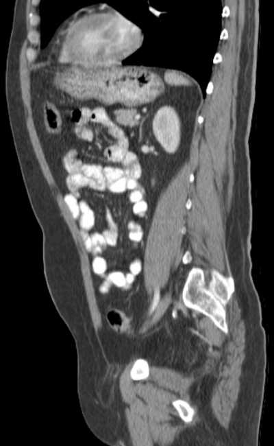 Bleeding duodenal ulcer and adenomyomatosis of gallbladder (Radiopaedia 61834-69861 C 66).jpg