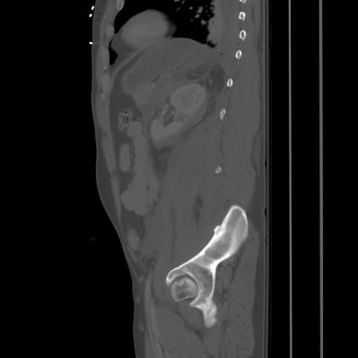 Blunt abdominal trauma with solid organ and musculoskelatal injury with active extravasation (Radiopaedia 68364-77895 Sagittal bone window 77).jpg