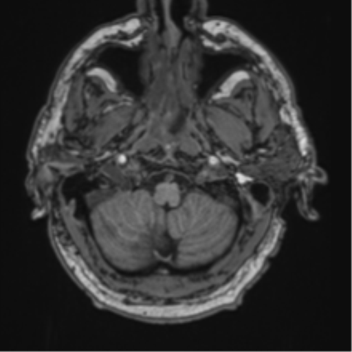 File:Blunt cerebrovascular injury (Radiopaedia 53682-59745 Axial T1 5).png