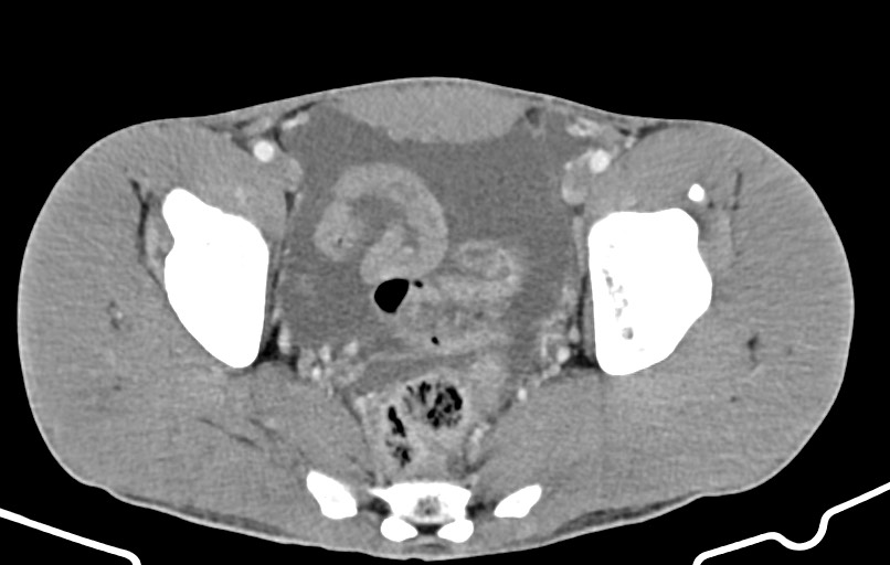 Blunt injury to the small bowel (Radiopaedia 74953-85987 A 170).jpg