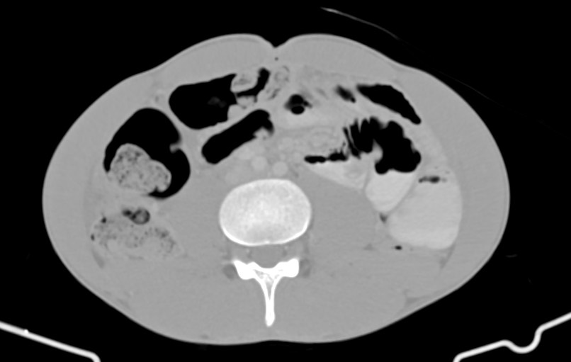 Blunt injury to the small bowel (Radiopaedia 74953-85987 Axial Wide 52).jpg