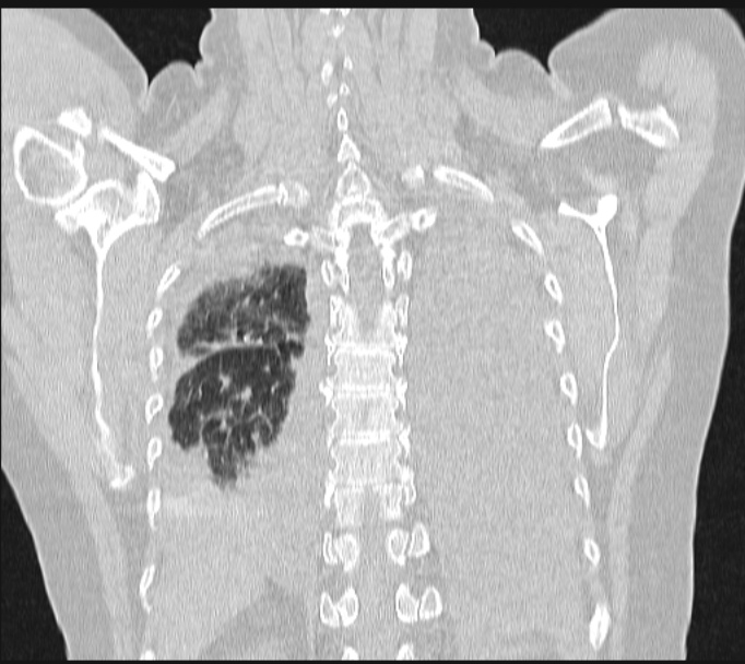 Boerhaave syndrome (Radiopaedia 45644-49799 Coronal lung window 55).jpg