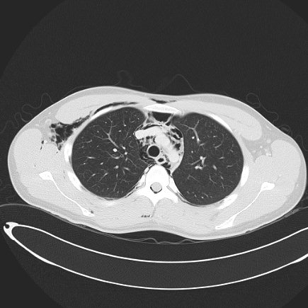Boerhaave syndrome with mediastinal, axillary, neck and epidural free gas (Radiopaedia 41297-44115 Axial lung window 39).jpg