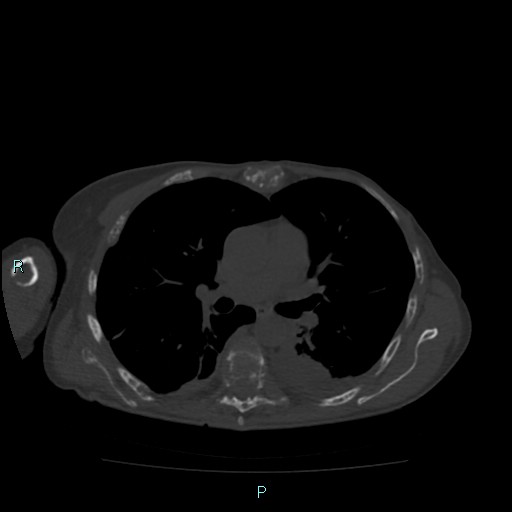 Bone metastases from untreated breast cancer (Radiopaedia 42973-46219 Axial bone window 47).jpg
