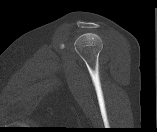 Bony Bankart and Hill-Sachs lesions (Radiopaedia 33622-34727 Sagittal bone window 23).png