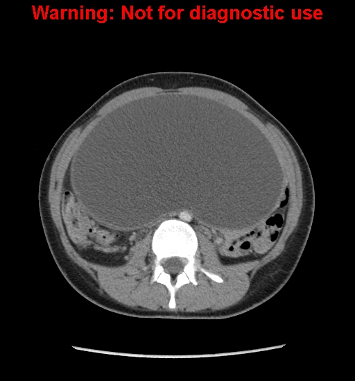 Borderline mucinous cystadenoma of ovary (Radiopaedia 25586-25767 A 27).jpg