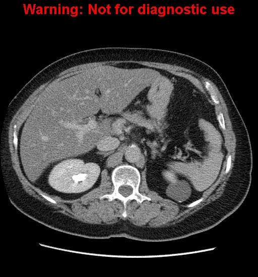 File:Bosniak renal cyst - type II (Radiopaedia 23404-23468 F 17).jpg
