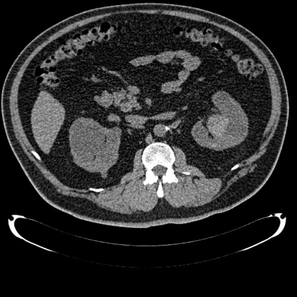Bosniak renal cyst - type IV (Radiopaedia 24244-24518 Axial non-contrast 141).jpg