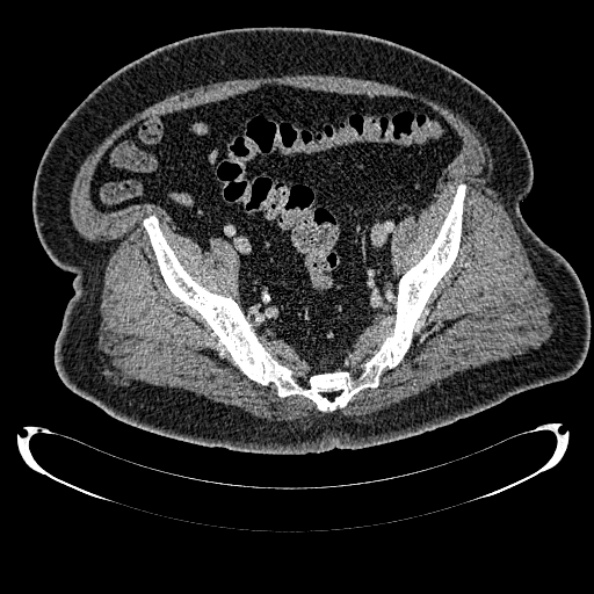 Bosniak renal cyst - type IV (Radiopaedia 24244-24518 C 330).jpg