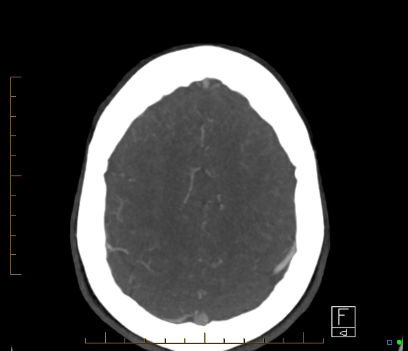 Brachiocephalic trunk stenosis (Radiopaedia 87242-103519 A 14).jpg