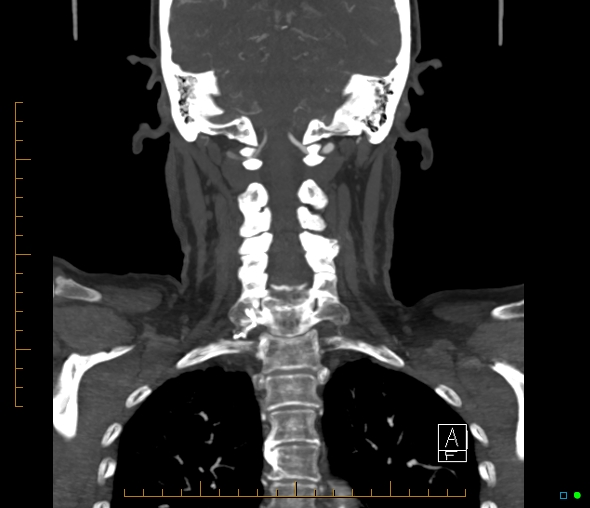 Brachiocephalic trunk stenosis (Radiopaedia 87242-103519 B 50).jpg
