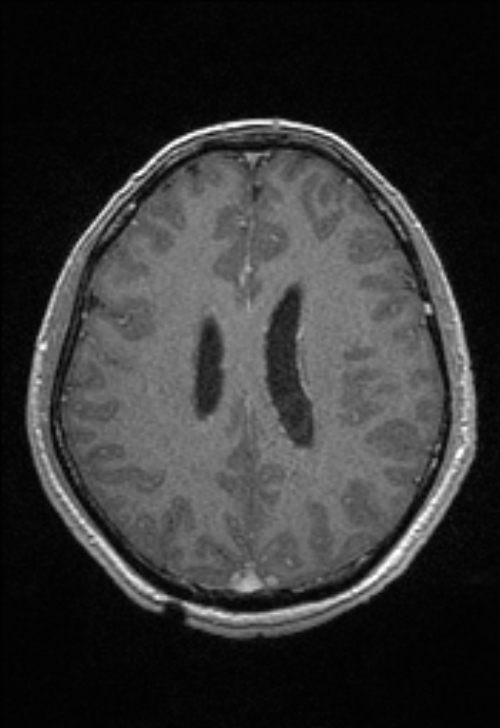 Brain abscess with ventriculitis (Radiopaedia 85703-101495 Axial T1 C+ 117).jpg