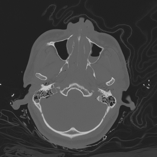 Brain contusions, internal carotid artery dissection and base of skull fracture (Radiopaedia 34089-35339 Axial bone window 48).png