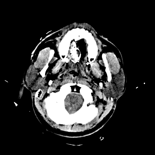 File:Brain contusions, internal carotid artery dissection and base of skull fracture (Radiopaedia 34089-35339 Axial non-contrast 15).png
