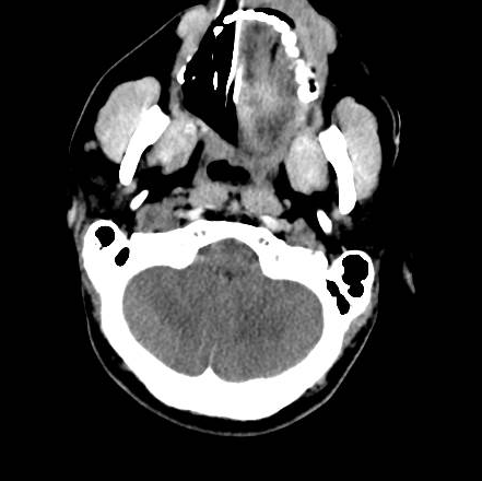 File:Brain death after motor vehicle collision (Radiopaedia 88470-105114 Axial 23).png