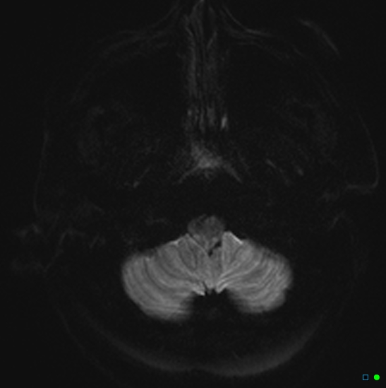 File:Brain death on MRI and CT angiography (Radiopaedia 42560-45689 Axial DWI 2).jpg