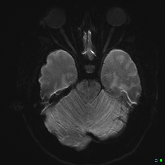 File:Brain death on MRI and CT angiography (Radiopaedia 42560-45689 Axial DWI 8).jpg