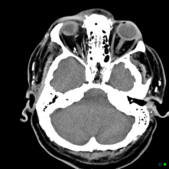 Brain death on MRI and CT angiography (Radiopaedia 42560-45841 B 39).jpg