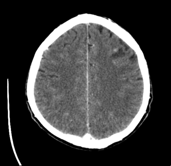 File:Brain metastases from lung cancer (Radiopaedia 24480-24781 Axial C+ delayed 44).jpg