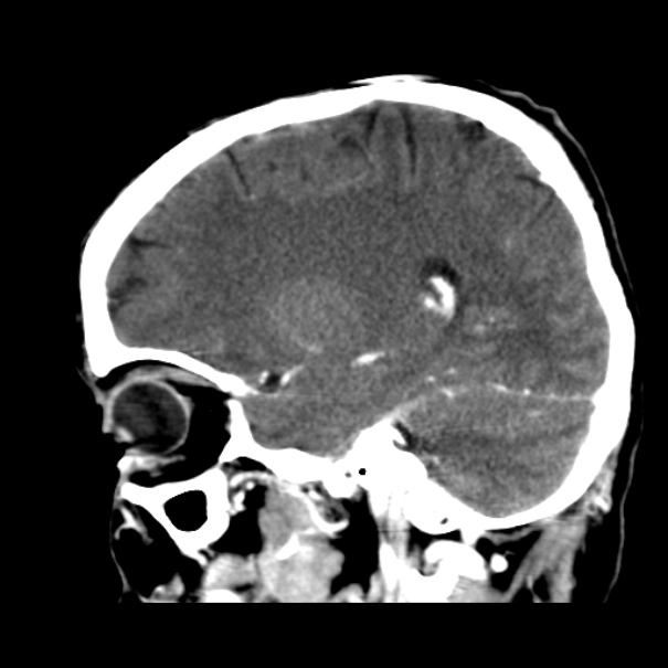 Brain metastases from lung cancer (Radiopaedia 24480-24781 C+ delayed 20).jpg