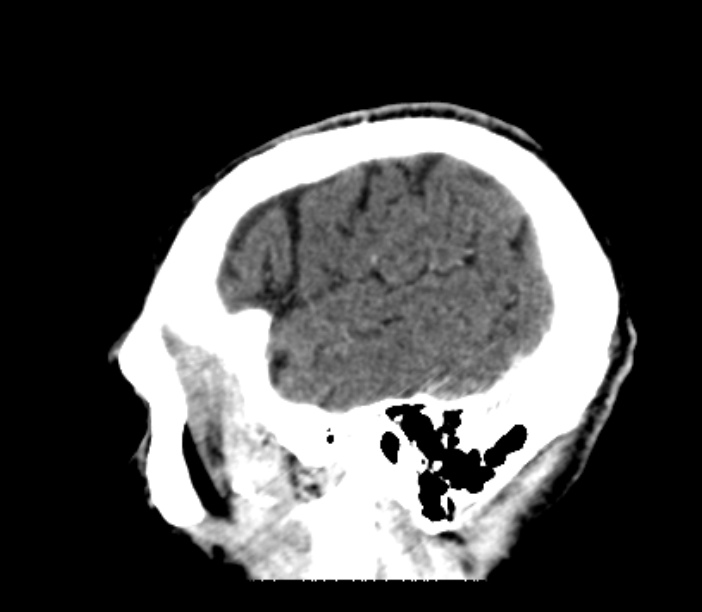 Brain metastases from lung cancer (Radiopaedia 27849-28092 Sagittal C+ delayed 52).jpg
