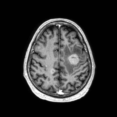 File:Brain metastases from lung cancer (Radiopaedia 83839-99028 Axial T1 C+ 51).jpg
