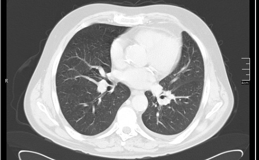 Brain metastases from squamocellular lung cancer (Radiopaedia 56515-63219 Axial lung window 37).jpg
