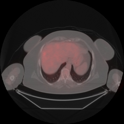 Brain metastasis (Radiopaedia 89847-106962 Axial lung window 52).jpg