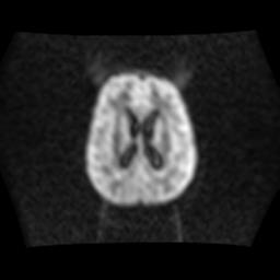 File:Brainstem glioma (Radiopaedia 30923-31624 Axial DWI 12).jpg