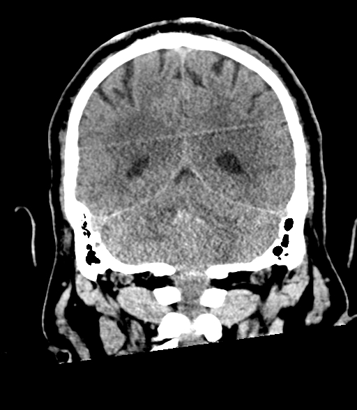 Brainstem hemorrhage (Radiopaedia 81294-94976 Coronal non-contrast 49).jpg