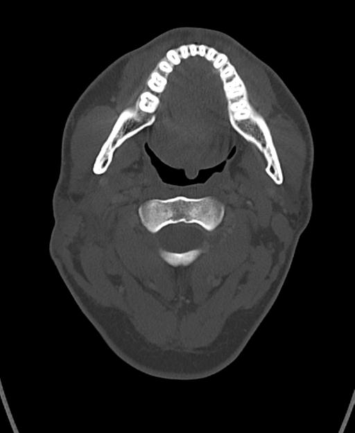 Branchial cleft cyst (Radiopaedia 31167-31875 Axial bone window 23).jpg