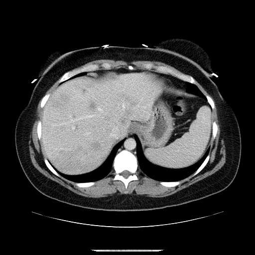 Breast cancer pseudocirrhosis after chemotherapy (Radiopaedia 65407-74456 A 17).jpg