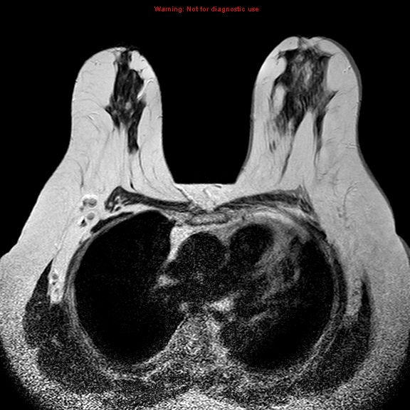 File:Breast carcinoma (multicentric multifocal in mammary Paget disease) (Radiopaedia 50966-56512 Axial T2 12).jpg