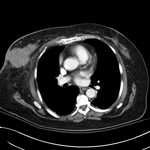 Breast carcinoma with pathological hip fracture (Radiopaedia 60314-67974 A 28).jpg
