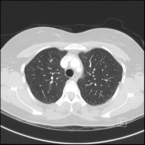 Breast metastases from renal cell cancer (Radiopaedia 79220-92225 Axial lung window 22).jpg