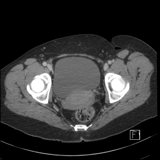 File:Breast metastases from renal cell cancer (Radiopaedia 79220-92225 C 110).jpg