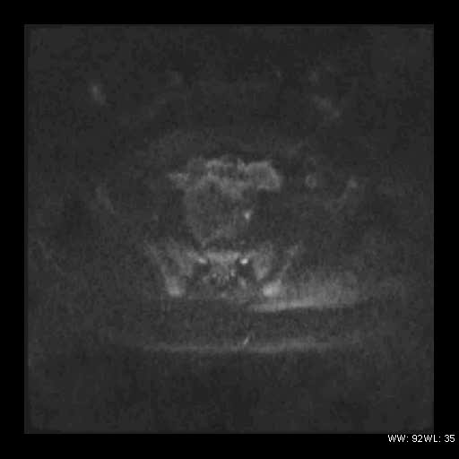 File:Broad ligament fibroid (Radiopaedia 49135-54241 Axial DWI 14).jpg