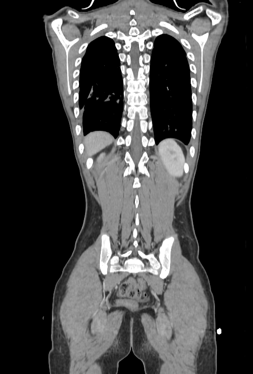 Bronchial carcinoid tumor (Radiopaedia 57187-64090 B 98).jpg