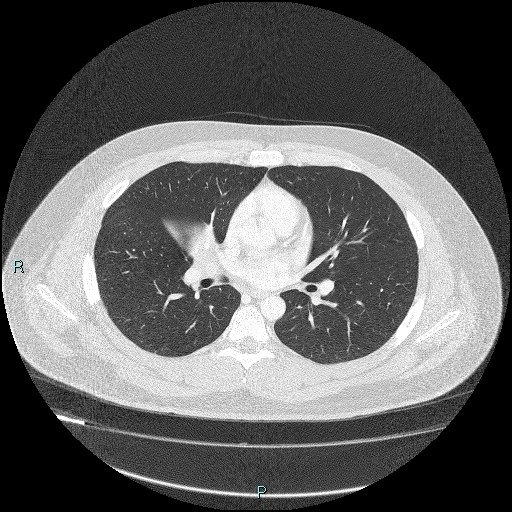 Bronchial carcinoid tumor (Radiopaedia 78272-90875 Axial lung window 25).jpg
