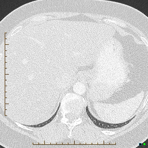 Bronchial diverticula (Radiopaedia 79512-92676 Axial lung window 200).jpg