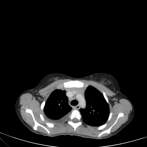 Bronchial mucoepidermoid carcinoma (Radiopaedia 57023-63895 Axial 29).jpg