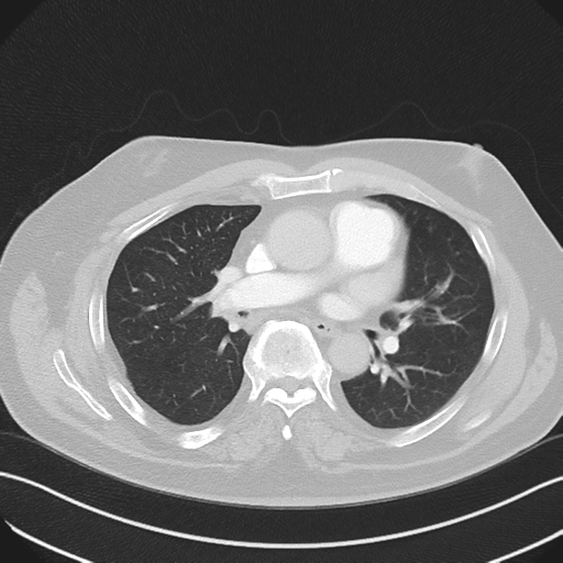 File:Bronchiectasis (Radiopaedia 39385-41666 Axial lung window 32).png
